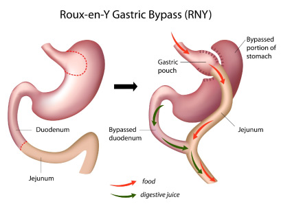 gastric bypass